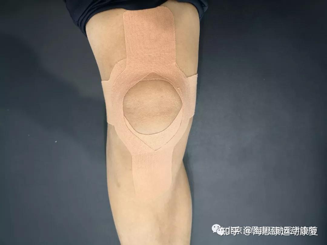 膝关节的物理外挂——肌贴解密|海思康运动医学诊所