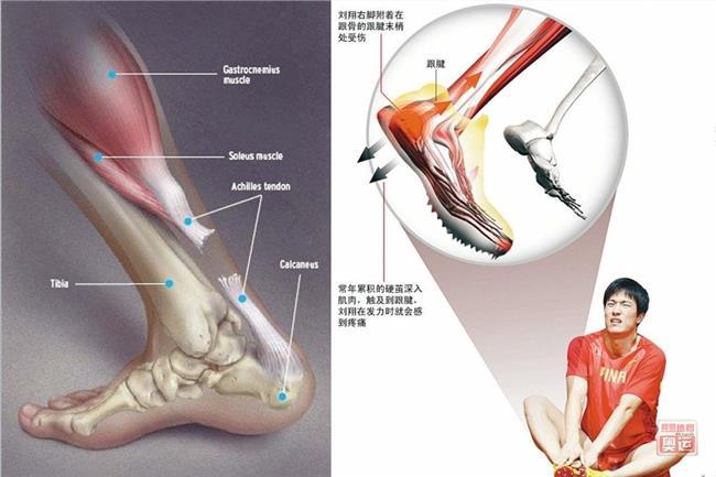 跟腱术后康复12周一年天津艾柯特运动康复中心