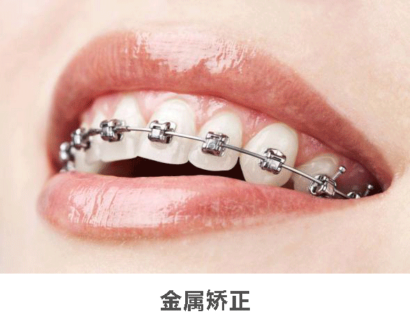 牙齿矫正保姆级攻略,让你明白颜值是如何偷偷上升的!——北京圣贝口腔