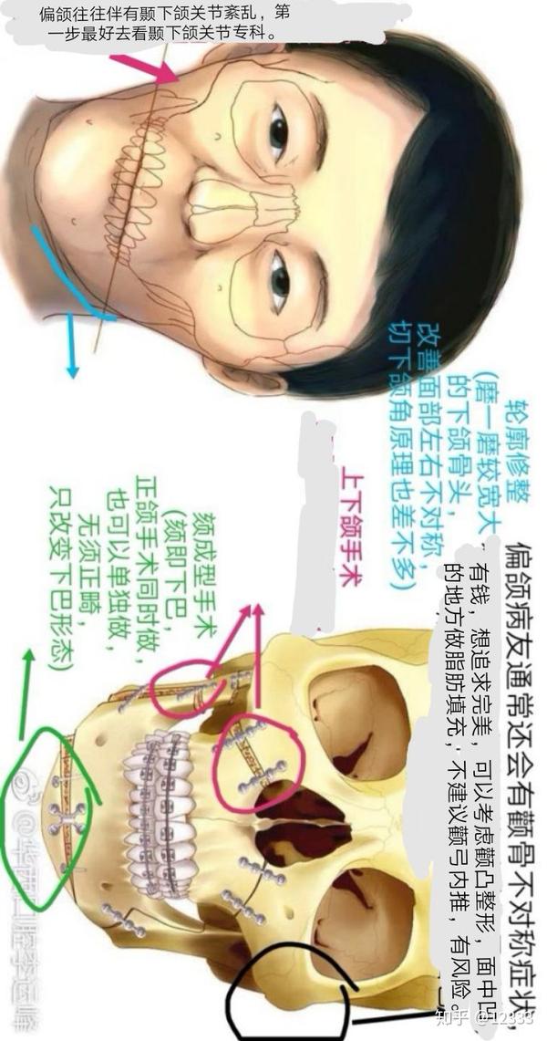 是我在百度上找的正颌截骨示意图,图一是大多数人做的上颌lefort手术