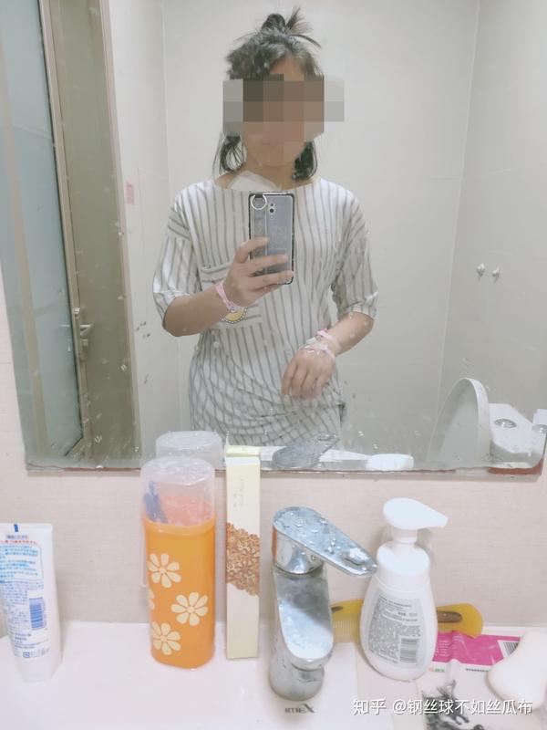 31岁斜颈手术过程心得