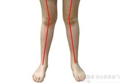 这两种腿型大多数都是因为扁平足和股骨内旋,所以我们要从膝盖以下和