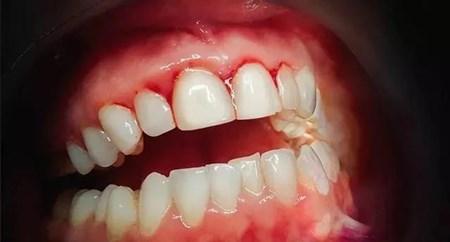 舒适治:牙龈红肿,松动,激光在牙周方面的应用