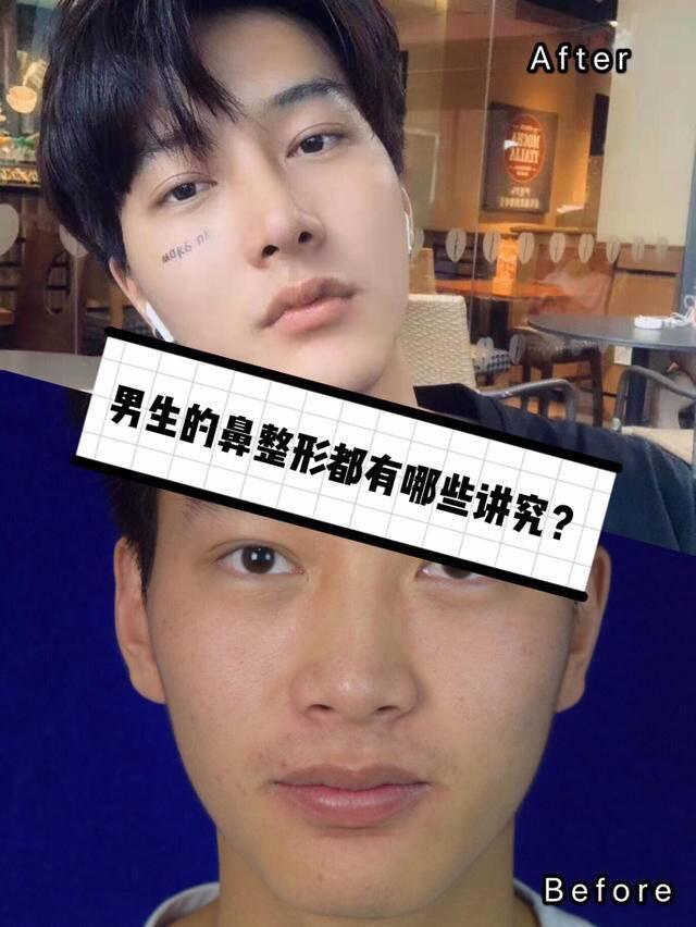 对于鼻整形,女生是占了很大一部分的比例,但是男生对鼻子的追求也不乏