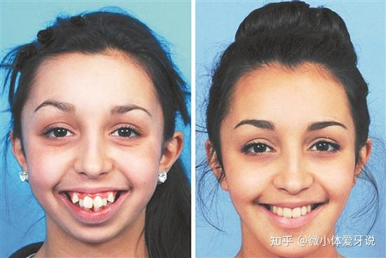 我收藏了一个牙齿矫正的经典案例,大家可以看下:牙齿矫正前后脸型对比