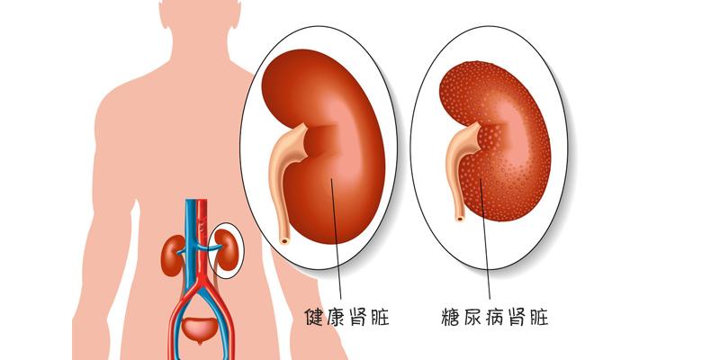 糖尿病肾病控制不好尿毒症就很近了