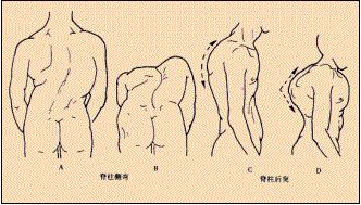 我仔细的检查了孩子的情况,确实是典型的轻度鸡胸,鸡胸与漏斗胸一样