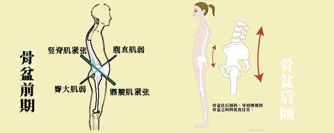 如何准确判断自己是骨盆前倾还是后倾或正常?