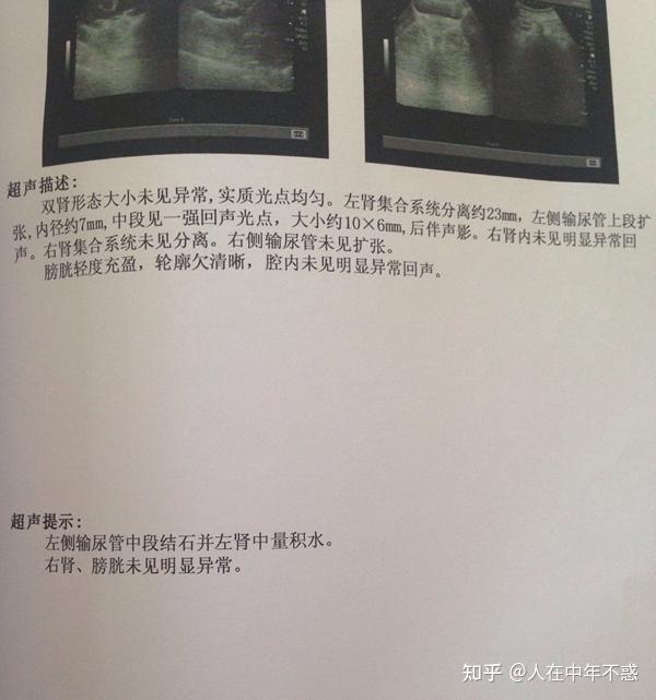 不敢相信折磨我许久的肾结石一天时间就顺利排出来了