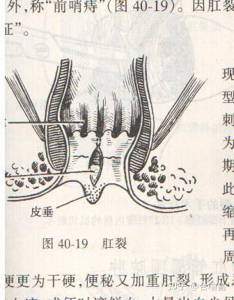 肛裂有哪些危害肛裂的症状