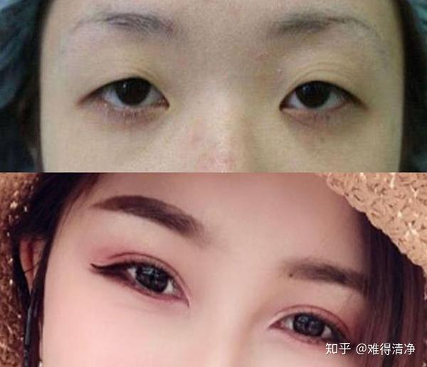 到底什么是眼综合整形?