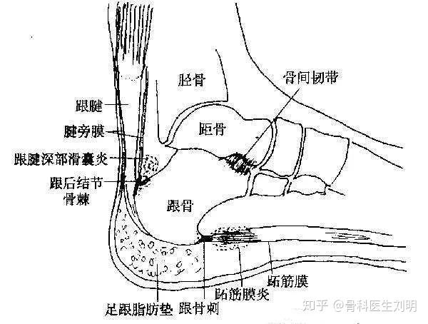 跖筋膜像弓弦一样拉紧维持足弓,各种原因的损伤会引起跖筋膜疼痛,典型