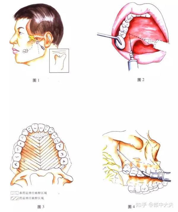 口腔医学—颌面外科常用麻醉方法图谱