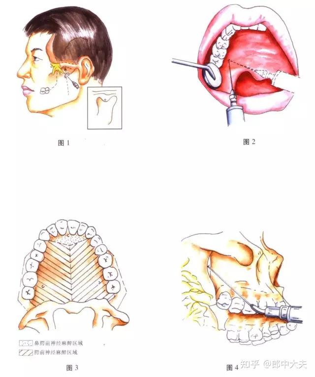 口腔医学颌面外科常用麻醉方法图谱