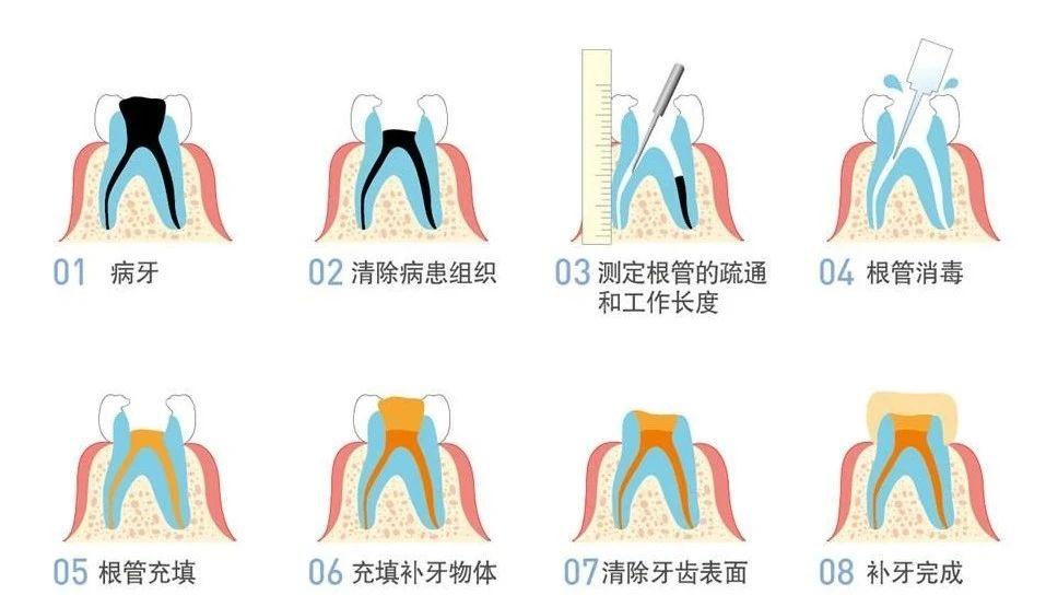 牙益在线根管治疗的那些事