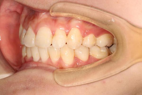 之后就是矫正结束后的牙齿情况,牙齿拥挤解除,咬合关系正常,牙龈呈现