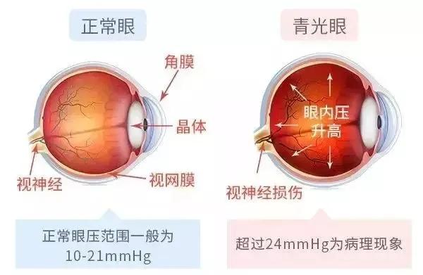 致盲眼疾年轻化青光眼白内障相互作用可严重影响视力