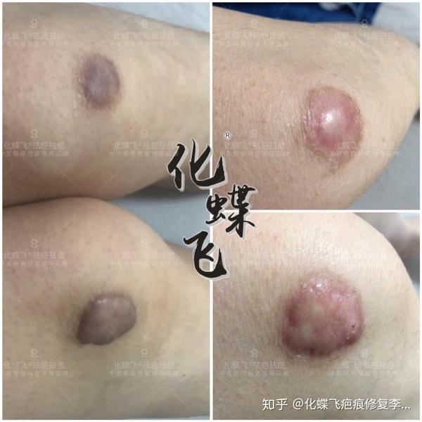 增生的疤痕疙瘩怎么治疗