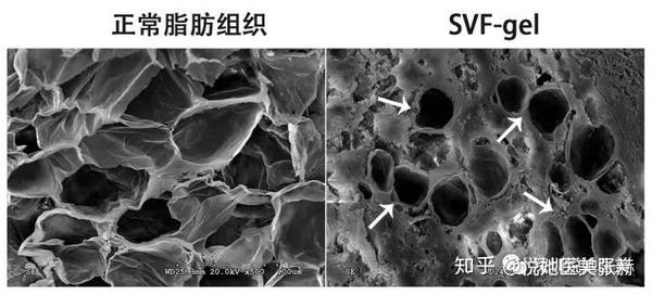 svf-gel自体脂肪干细胞胶是什么?