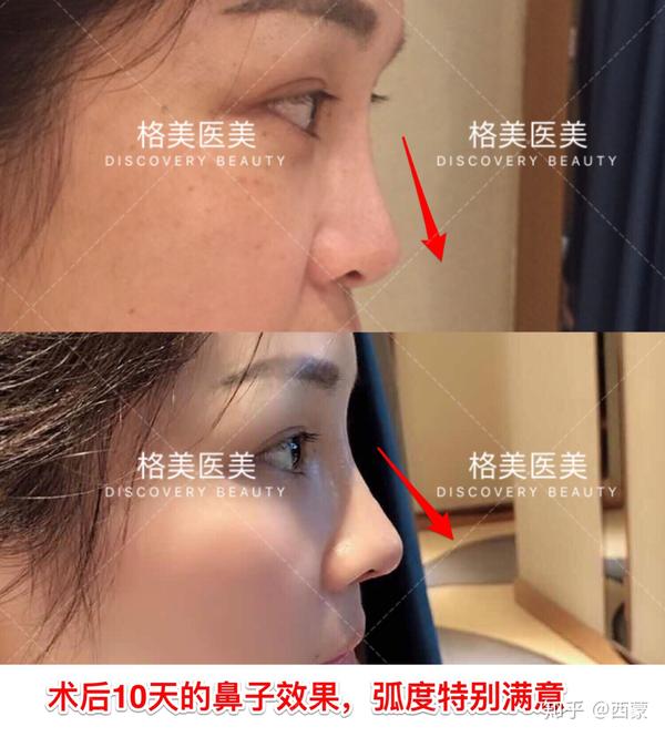 硅胶隆鼻好还是膨体好?