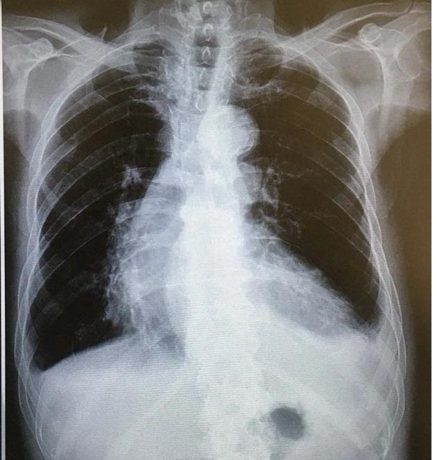 肺部肿瘤会导致胸腔积液吗 唐跃良?