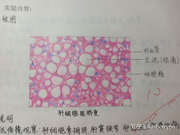 供学弟学妹们参考~ 1.肝细胞脂肪变性 2.肉芽组织 3.慢性肺淤血 4.