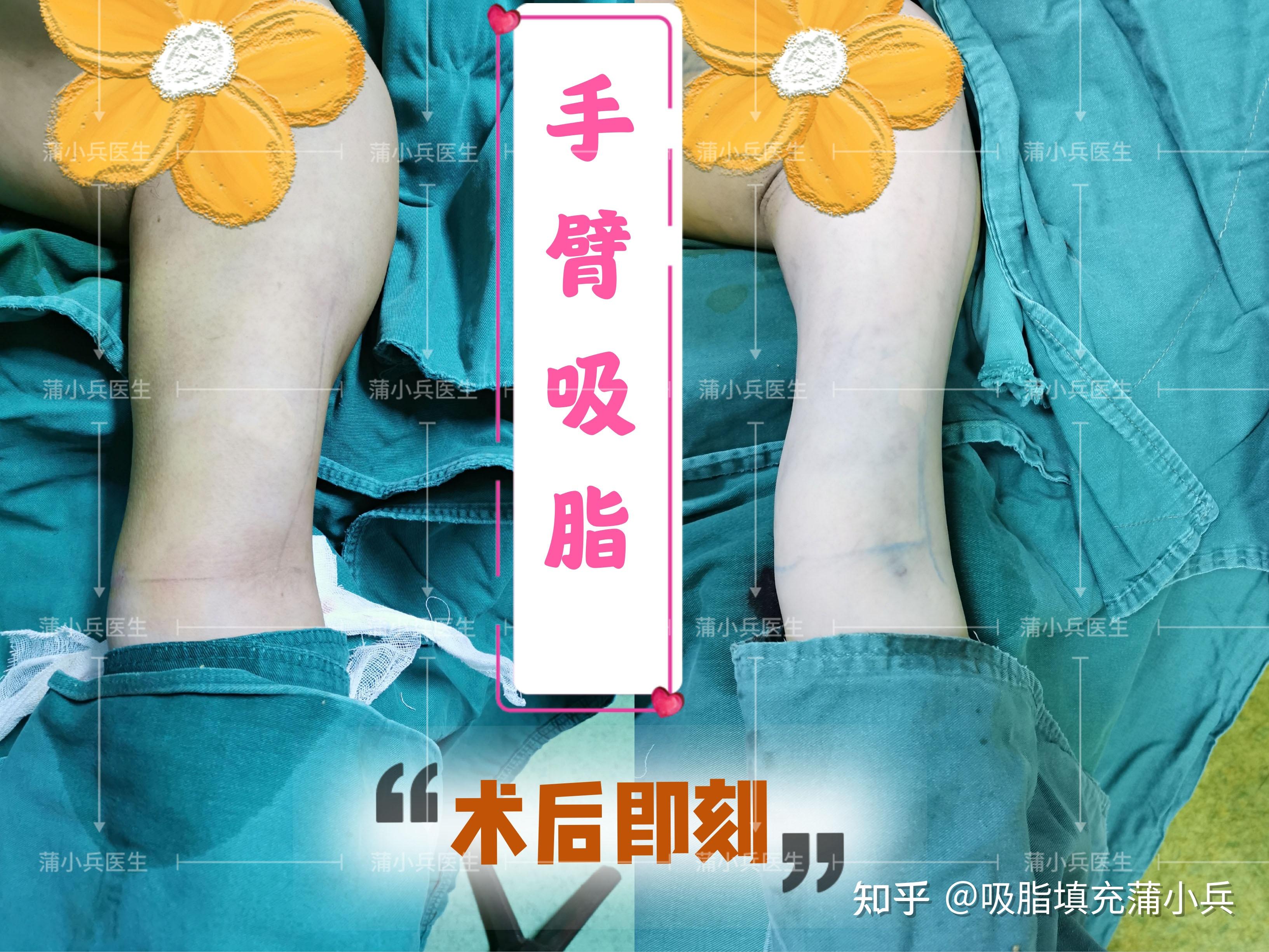 腰腹环吸加胳膊抽脂需要多少钱恢复期多久呢