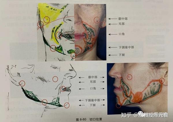 通过自体脂肪移植可以重建和加强下颌和颏部清晰的轮廓线.