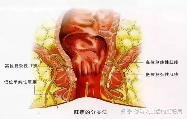 肛瘘是指肛管直肠与肛门周围皮肤相通的感染性管道,又称为"肛管
