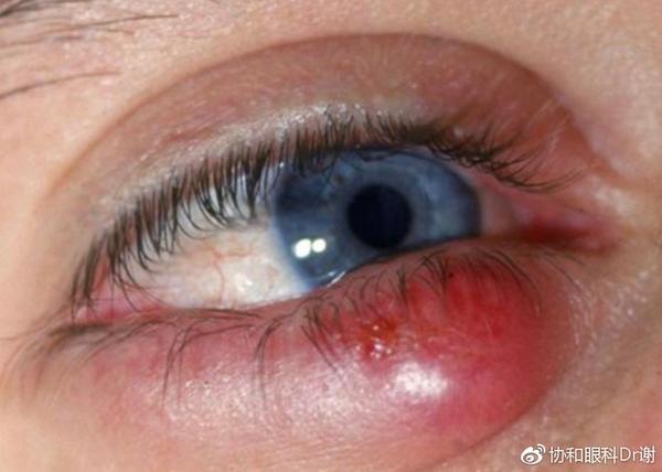 血管型黑眼圈是由血液循环不畅引起的,如熬夜引起,可以用热敷缓解.