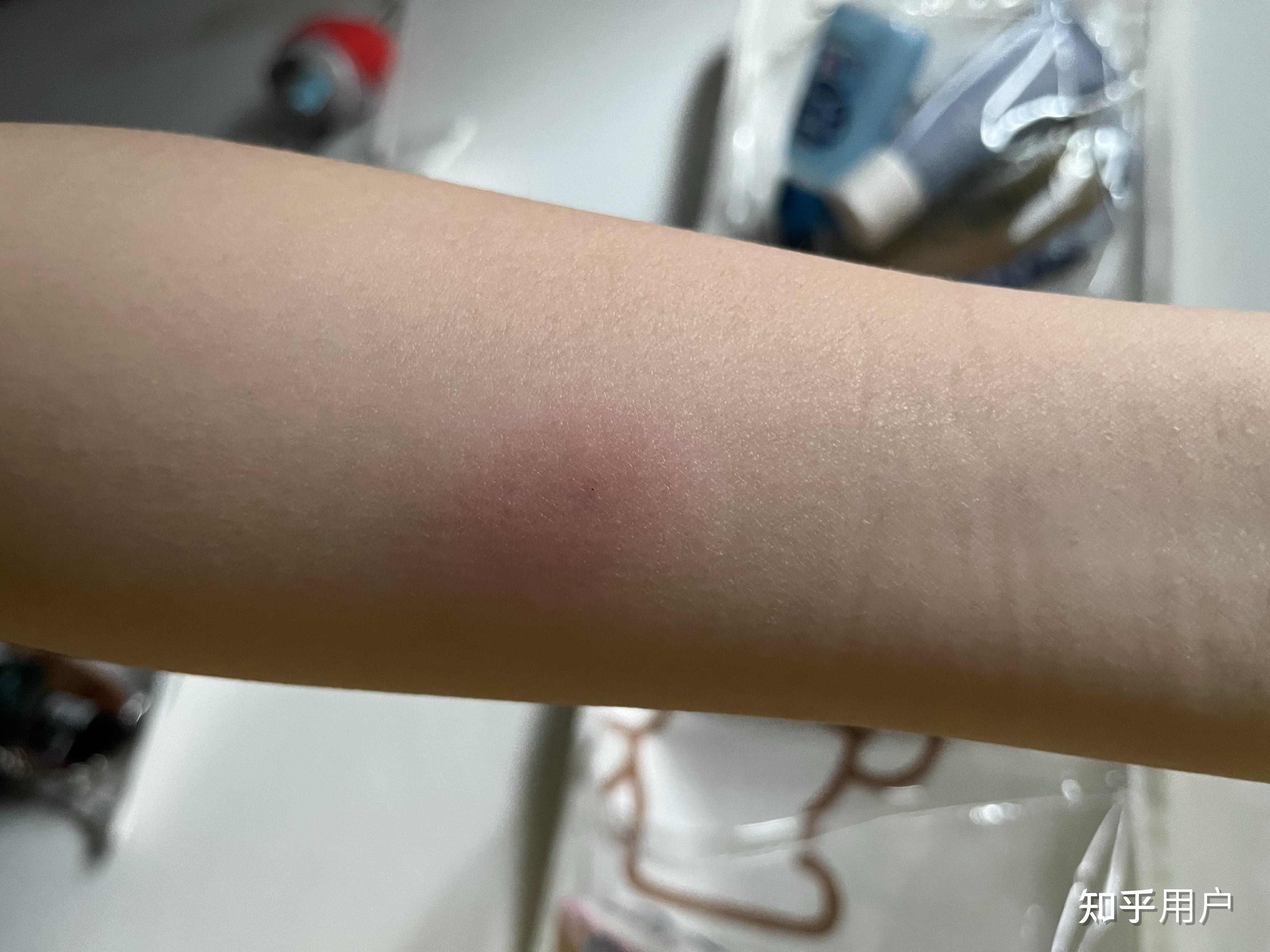 ppd皮试后这个样子怎么办