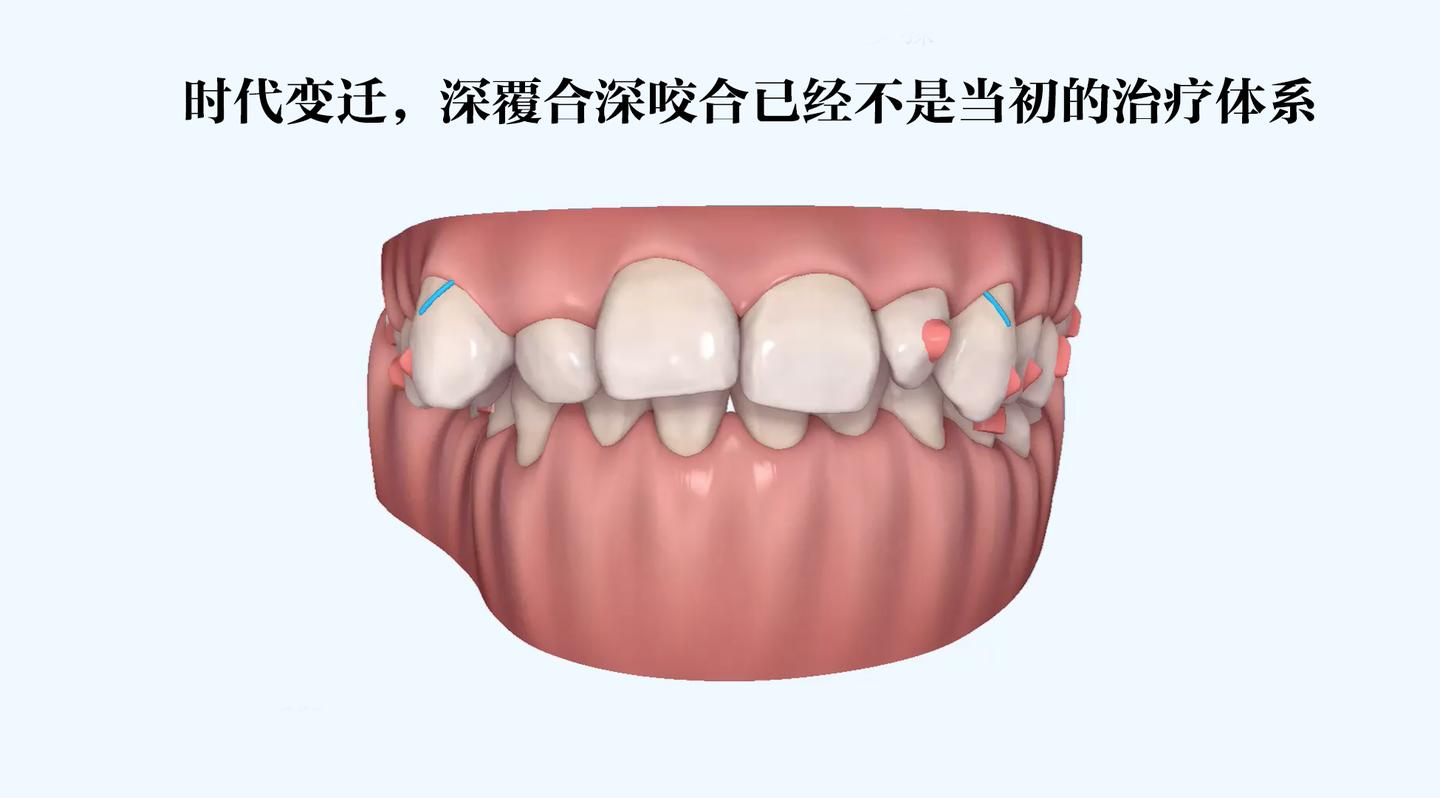 惠州牙齿矫正|时代变迁,深覆合深咬合已经不是当初的治疗体系