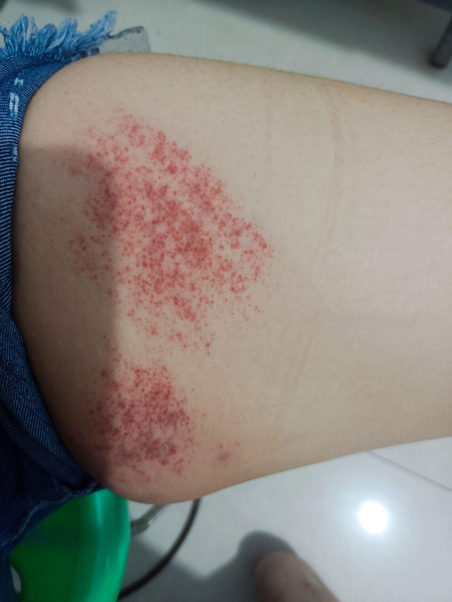 怎样消除被跳蚤咬的包