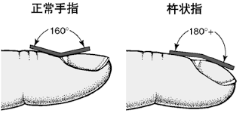 手指肿成萝卜头出现杵状指一定是肺癌吗