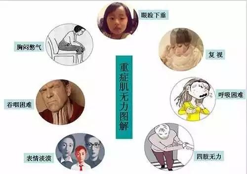 什么原因造成重症肌无力发生