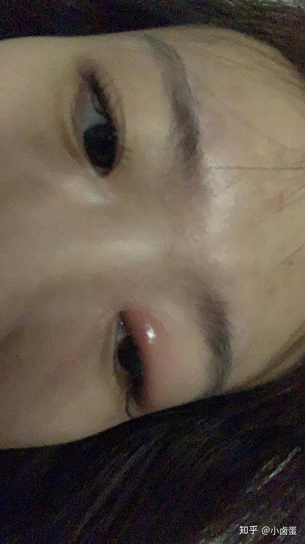一个小丑女了(只是暂时的 )医生说没法做手术 让我打针吃药滴眼药水