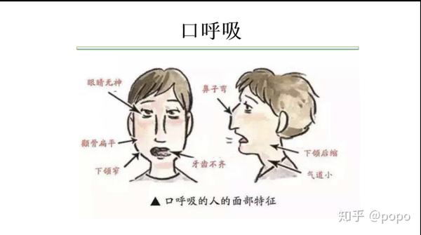 对于儿童口呼吸对面容的影响