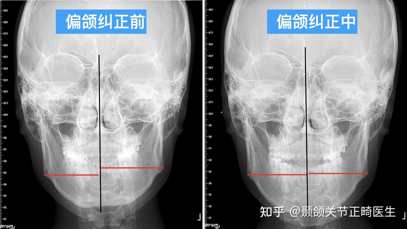 下颚骨不对称可以经常撑着低的那边去改善吗