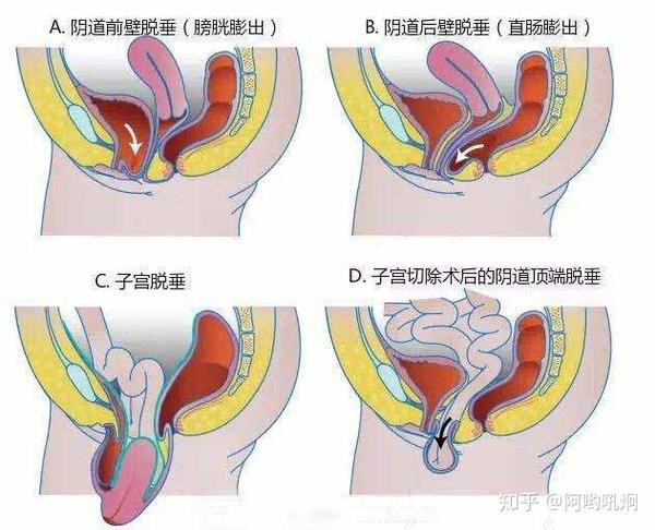 【干货】产后恢复跑步必读 | 脱垂与跑步