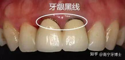 烤瓷牙:烤瓷牙的金属在口腔内能氧化形成灰色氧化物,散在沉积到牙龈