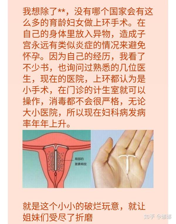 你如何看待女人上环这件事