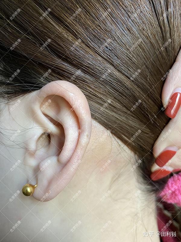 耳朵外伤疤痕疙瘩治疗后恢复的怎么样