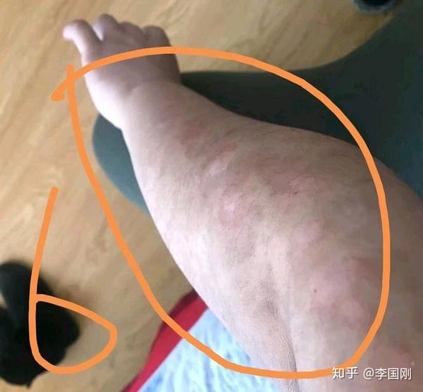 手臂点状银屑病消退顺序图片(辽宁.大连)