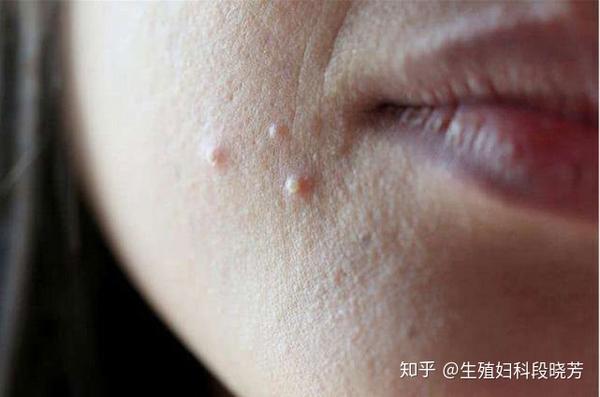 对号入座你离多囊有多远段晓芳开通互联网诊疗
