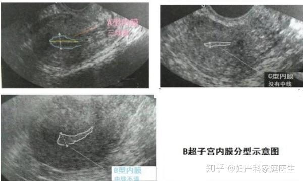 子宫内膜薄与宫腔粘连