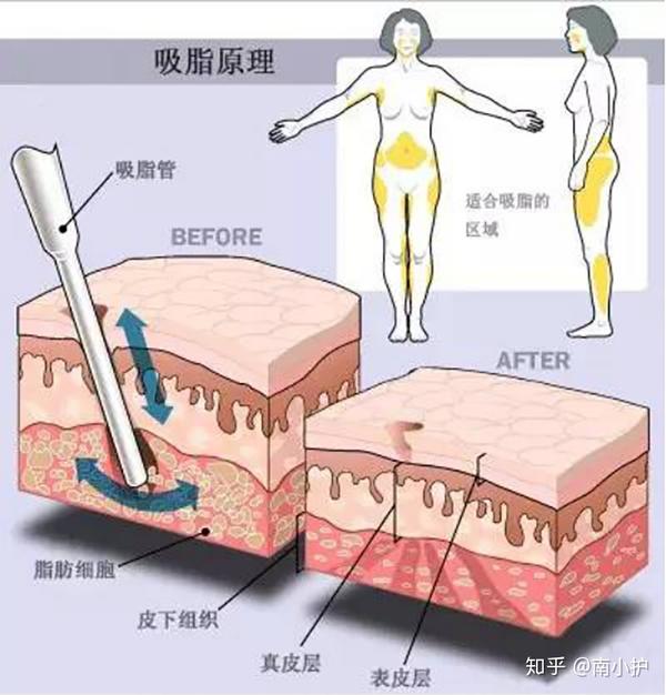 大家都知道腰腹部是最容易堆积脂肪的部位,简单来说,腰腹环吸大法就是