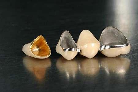 仙游种植牙:牙齿缺失选择哪种镶牙方式比较好?