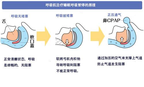 一文解读懂睡眠呼吸机在打呼噜中应用