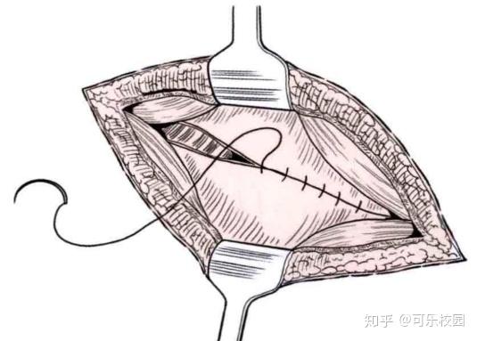 阑尾切除术