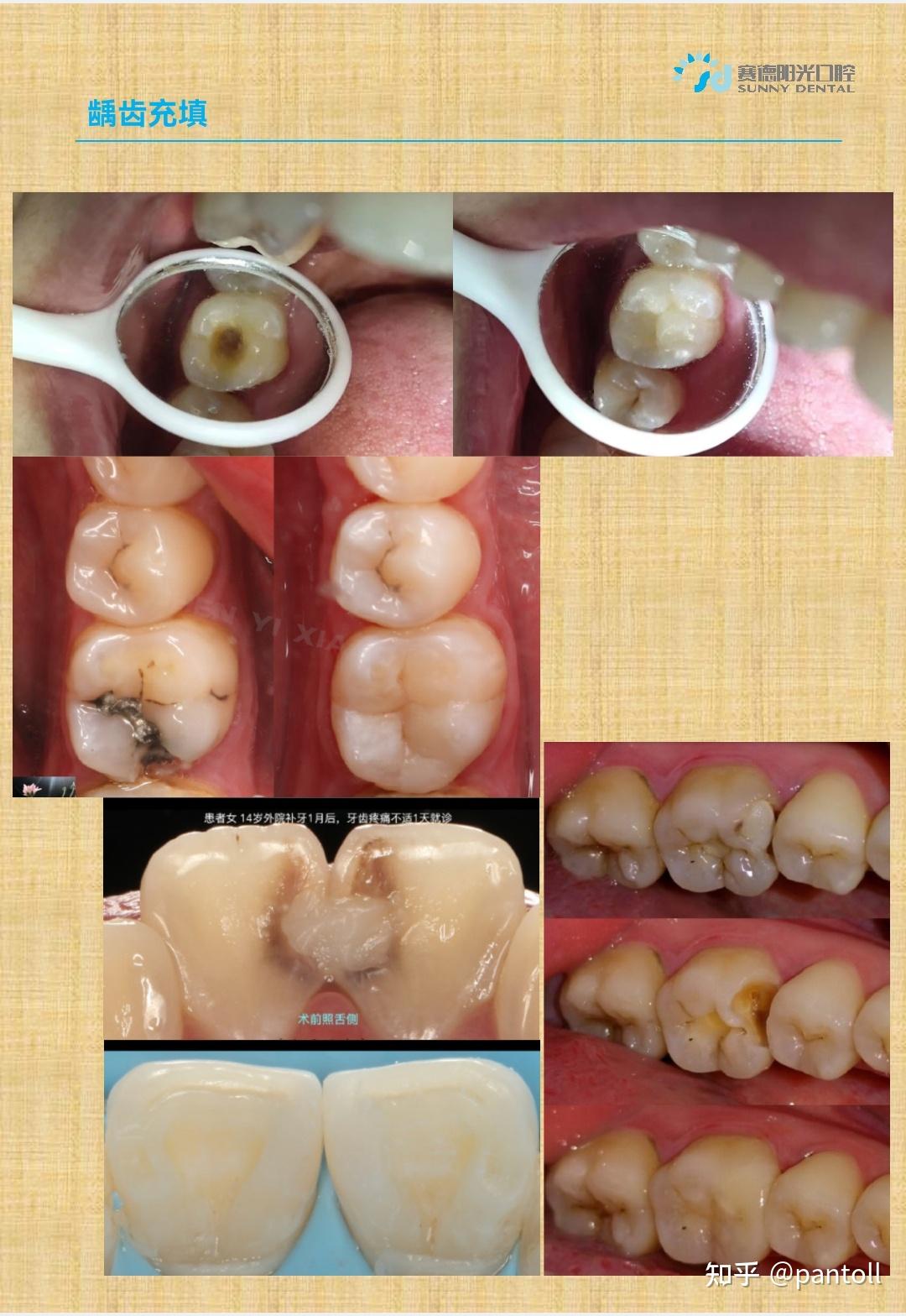 补牙的材料价格可以和牙医砍价吗?